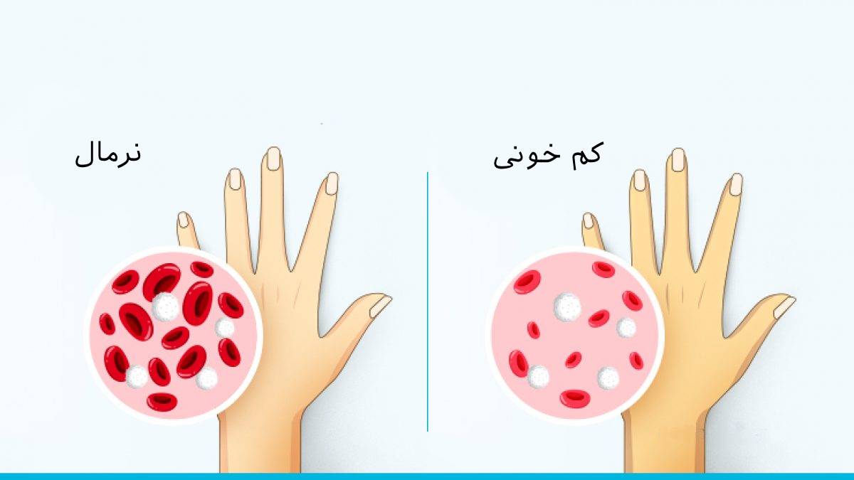 کم خونی