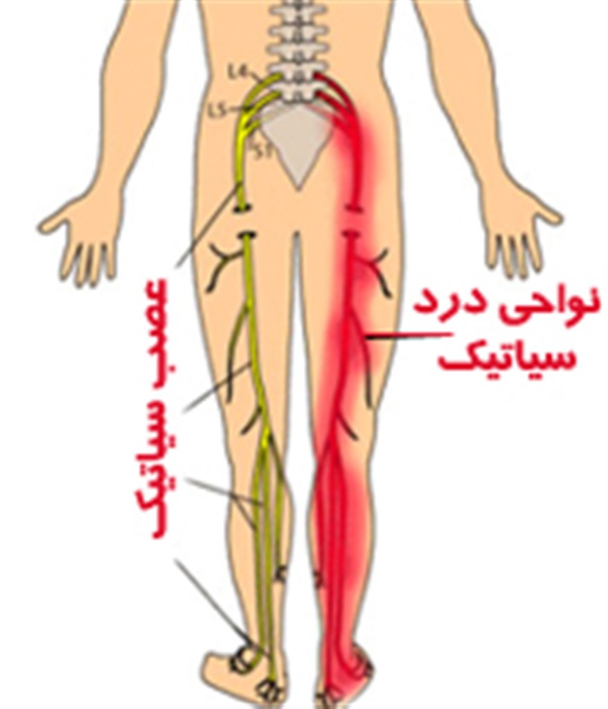 سیاتیک