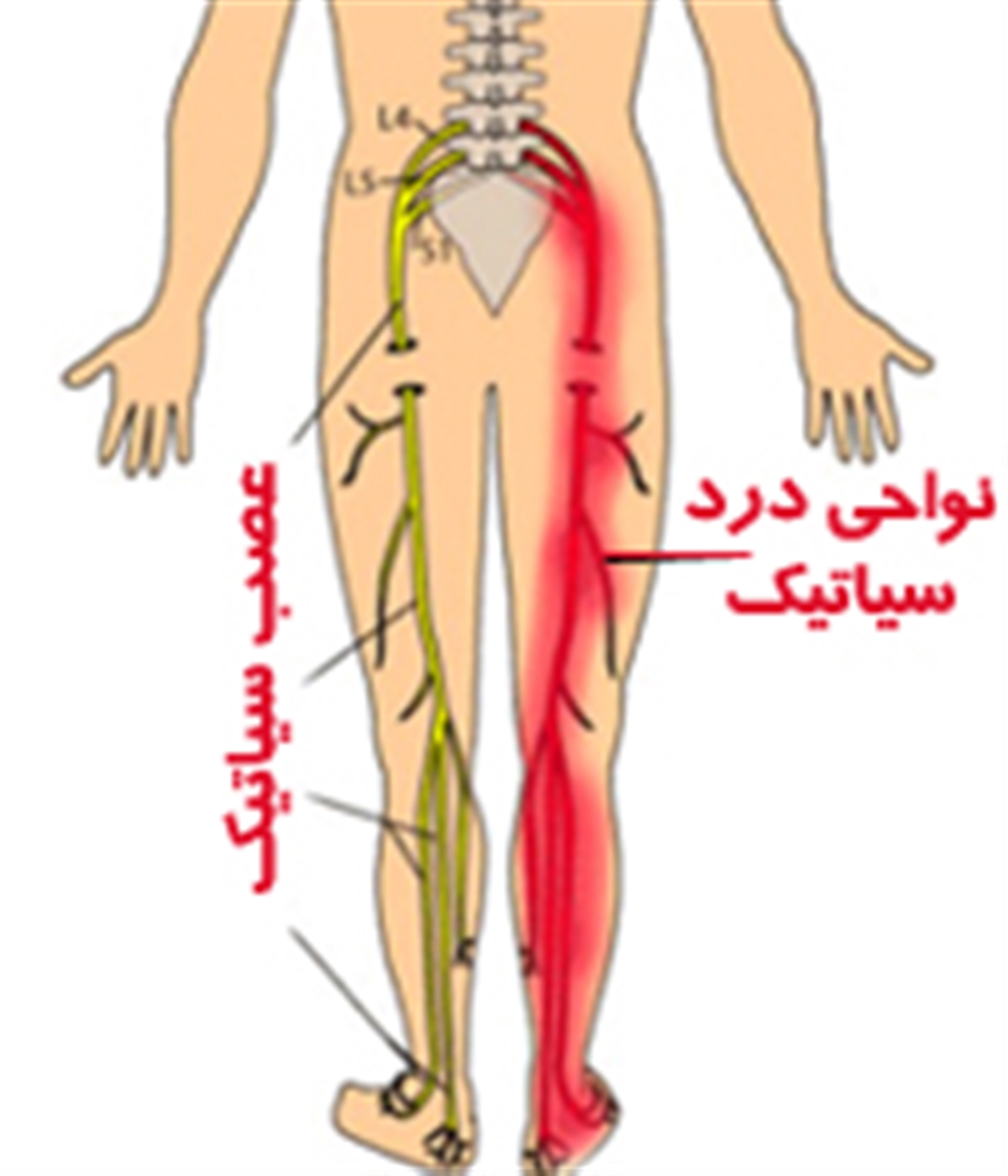 سیاتیک