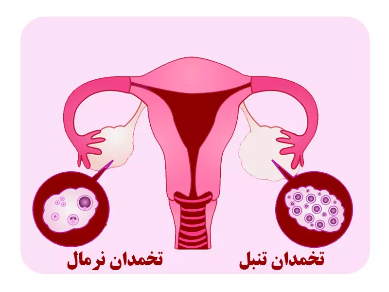 تنبلی تخمدان