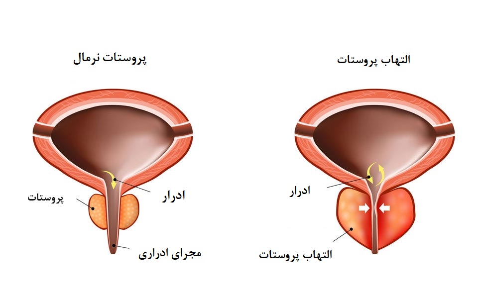 پروستات 