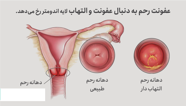 عفونت رحم