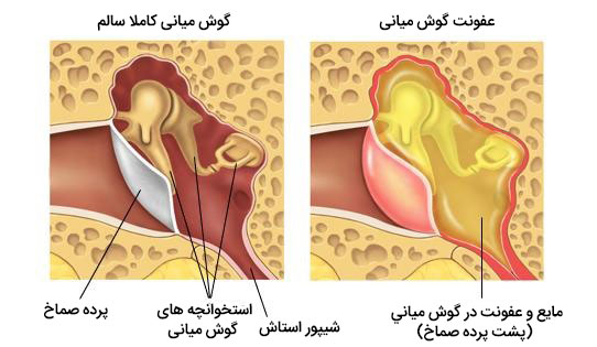 درمان عفونت و چرک گوش