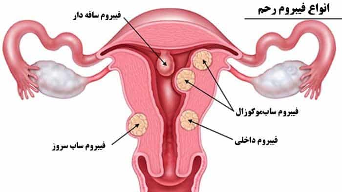فیبروم‌