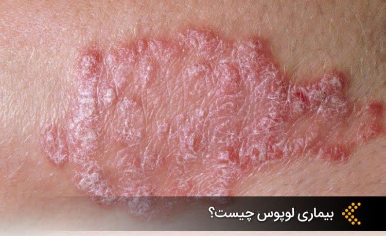 لوپوس