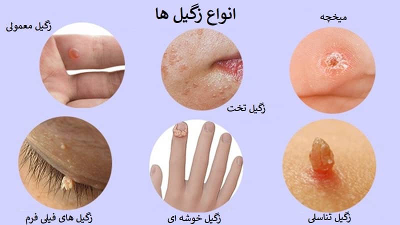 زگیل