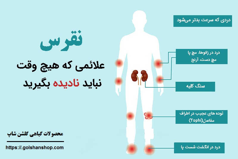 نقرس