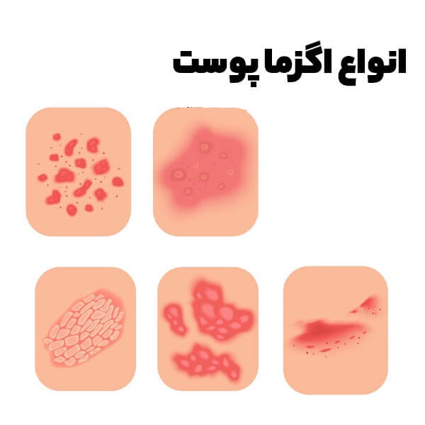 اگزما