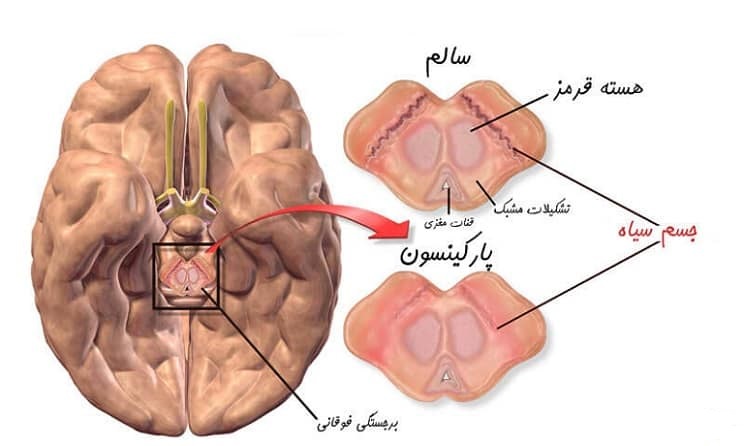 پارکینسون2