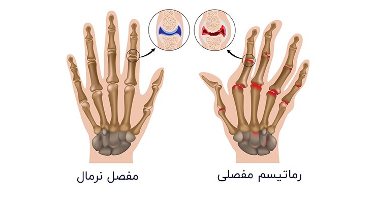 رماتیسم