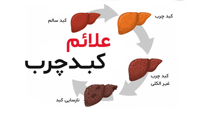 کبد چرب