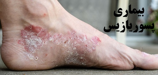 پسوریازیس