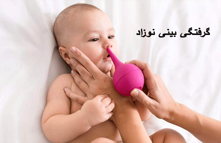گرفتگی بینی نوزاد