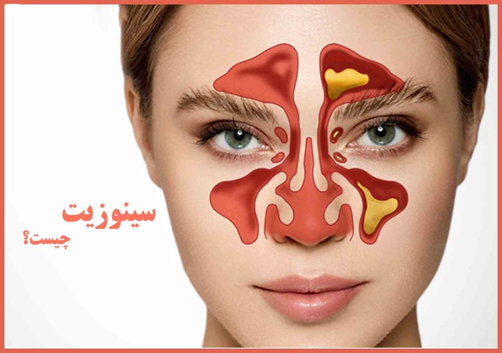 سینوزیت