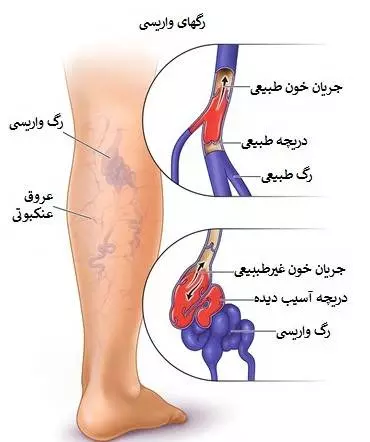 واریس