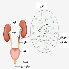 عفونت مجاری ادراری